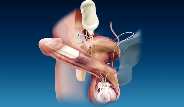 thick silicone and gel sealants